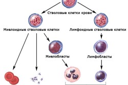 Трансплантация стволовых клеток при лейкозе