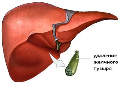 Удаление желчного пузыря