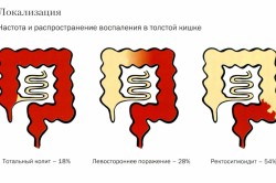 Виды неспецифического язвенного колита Виды неспецифического язвенного колита