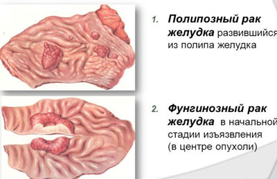 Картинка списка рака