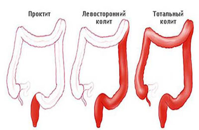 Типы колита