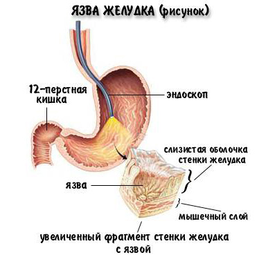 болезнь желудка рисунок