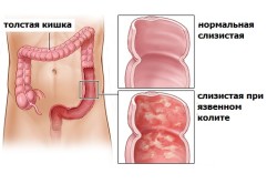 Сравнение здоровой слизистой и язвенного колита