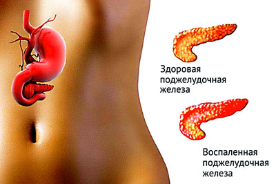 Воспаление поджелудочной железы