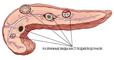 Киста поджелудочной железы