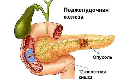 Симптомы рака поджелудочной железы