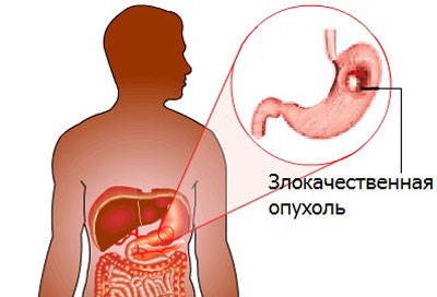 Рак желудка