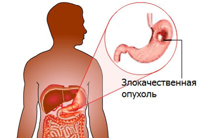 Рак желудка