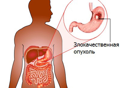 Рак желудка