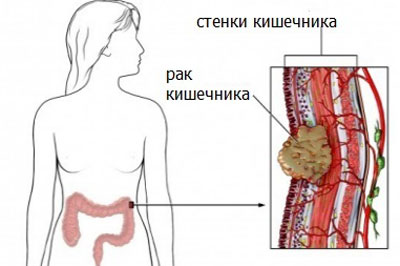 Признаки рака кишечника