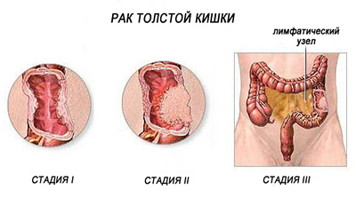 рак толстой кишки, стадии, рисунок