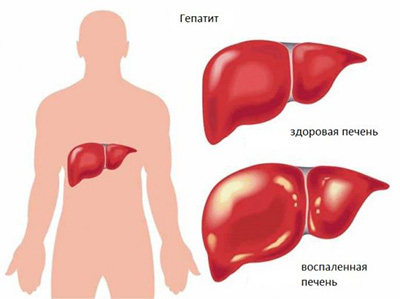 здоровая и больная печень