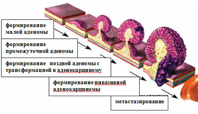 Стадии рака прямой кишки